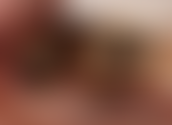 뿌리만남은치아 치관연장술 재신경치료 및 주조포스트 Crown lengthening, Re-endo Tx. & cast post crown 