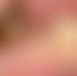 자연치아살리기 치아 발치 전 마지막 충치치료 : 뿌리만남은치아 소구치 주조포스트