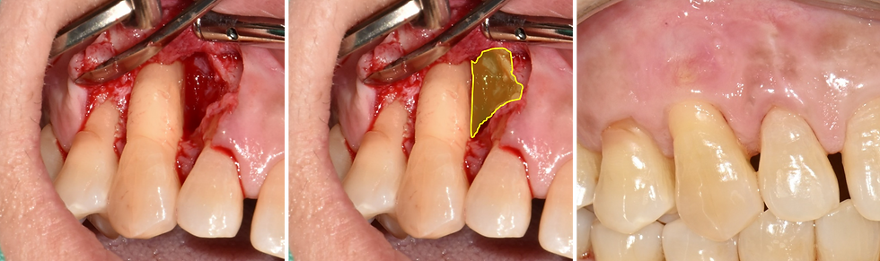 치주판막수술 중 확인한 Contained Defect 골 결손 양상
