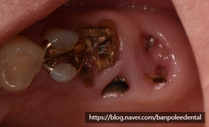 어금니가 부러져서 오신분 (발치즉시임플란트) (presentation of immediate implant placement)