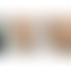 10년은 젊어지는 임플란트 보철 재건 - 다수 임플란트 발치즉시임플란트와 안모 변화 증례