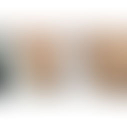10년은 젊어지는 임플란트 보철 재건 - 다수 임플란트 발치즉시임플란트와 안모 변화 증례