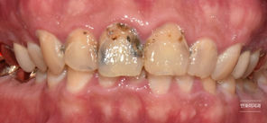 앞니 충치를 치료하러 오신 환자분 (심미보철수복) (Treatment of tooth decay & Esthetic zirconia crown restoration)