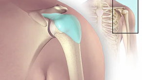 BURSITIS SUBACROMIAL o DE HOMBRO