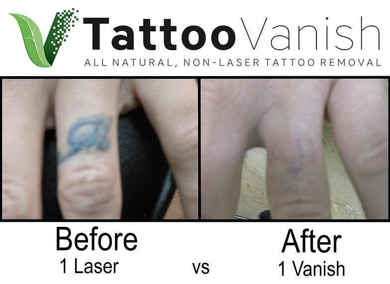 Best Tattoo Removal In Miami Best Tattoo Removal In Miami