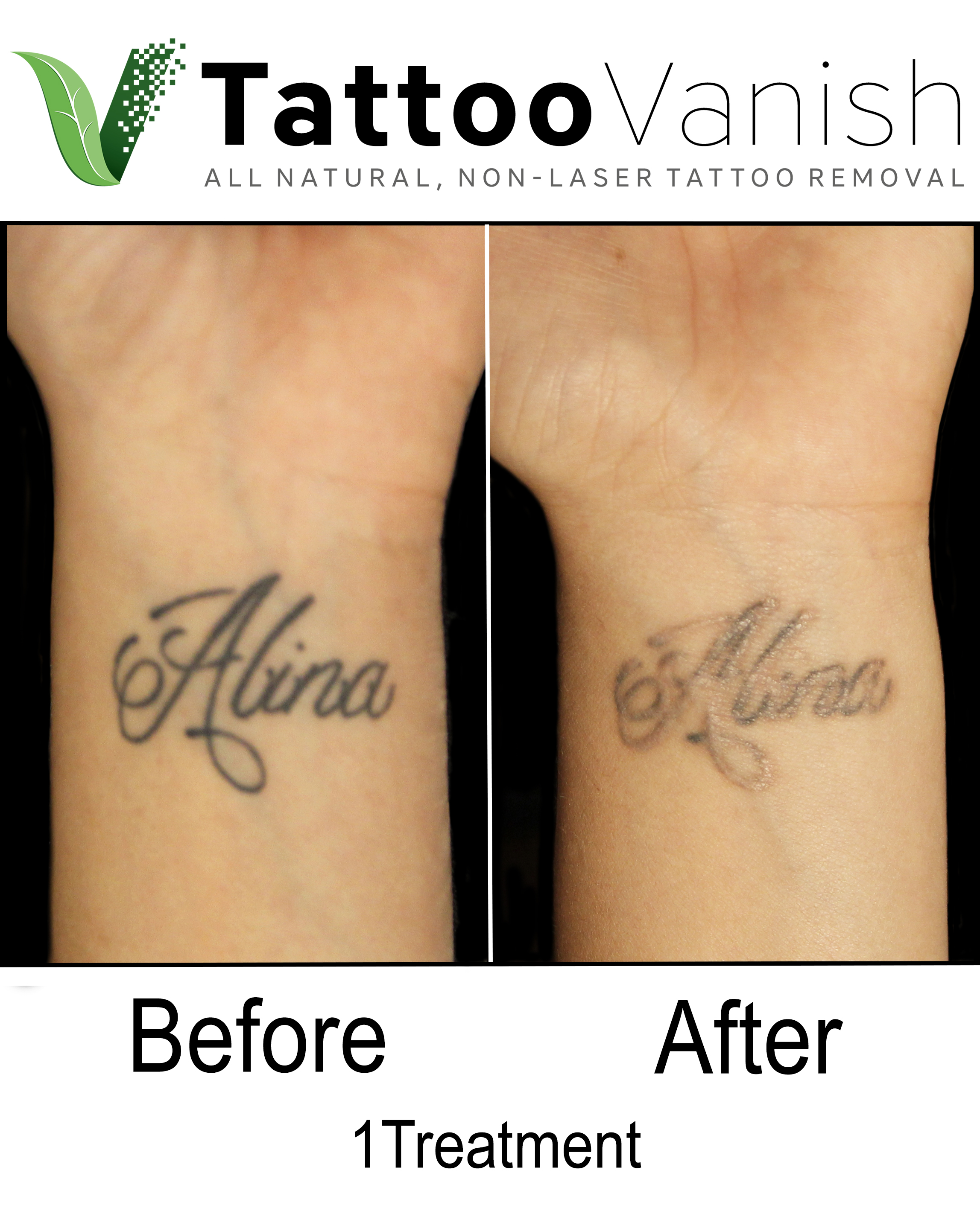 Best Tattoo Removal in Miami | All-Natural &amp; Non-Laser ...