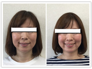 顔ヨガ効果