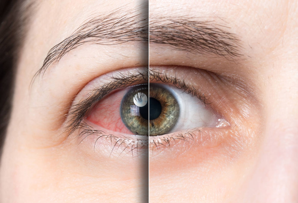 What Is Astigmatism & How Does It Affect My Vision?
