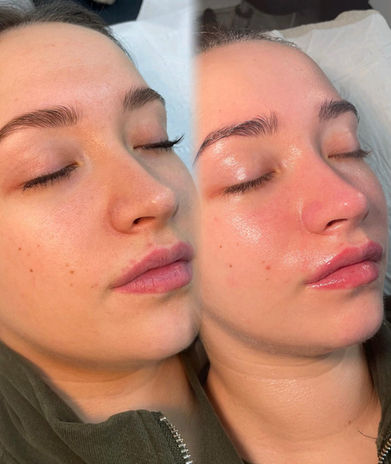 AJH Advanced beauty before and after facial services
