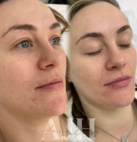 AJH Advanced beauty before and after facial services