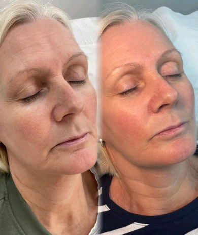 AJH Advanced beauty before and after facial services