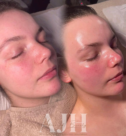 AJH Advanced beauty before and after facial services