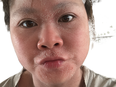 Navigating Topical Steroid Withdrawal (TSW) : A Personal Journey