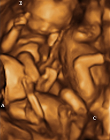 Fredericksburg Ultrasound Studio - Peek A Boo