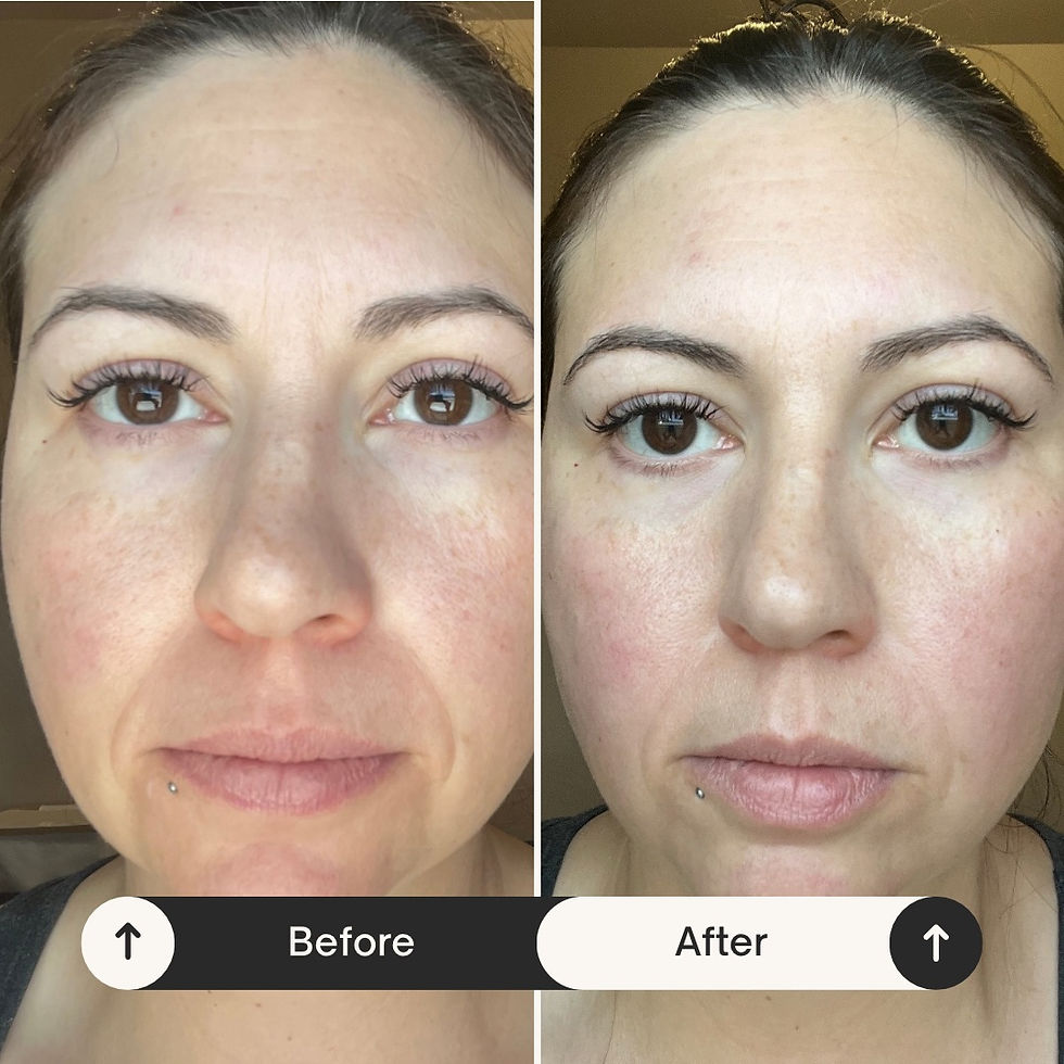 This is a before & after from a facial cupping session — notice the softer jawline, reduced puffiness , and overall more relaxed look.