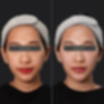 Lipocyte Face