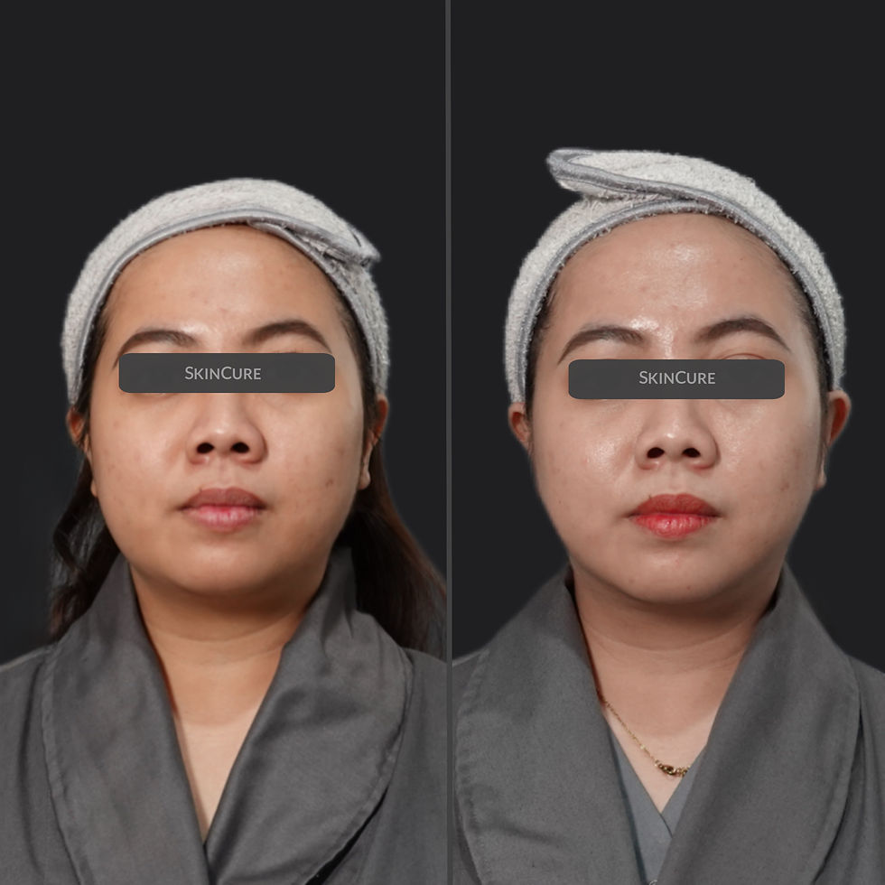 FaceTite