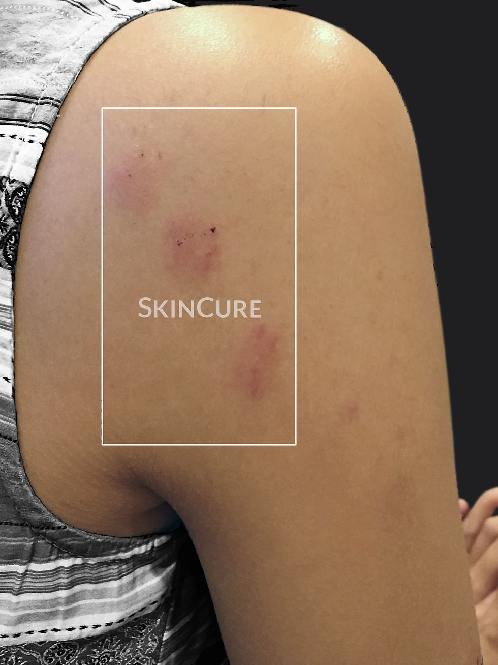 Insect Bites