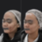 Acne Vulgaris
