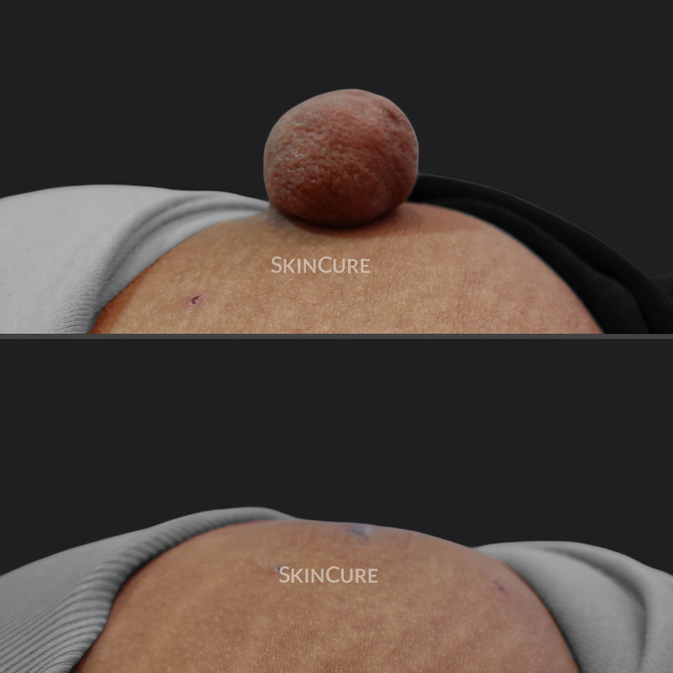 Giant Skin Tag