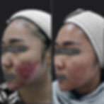 Acne Excoriae