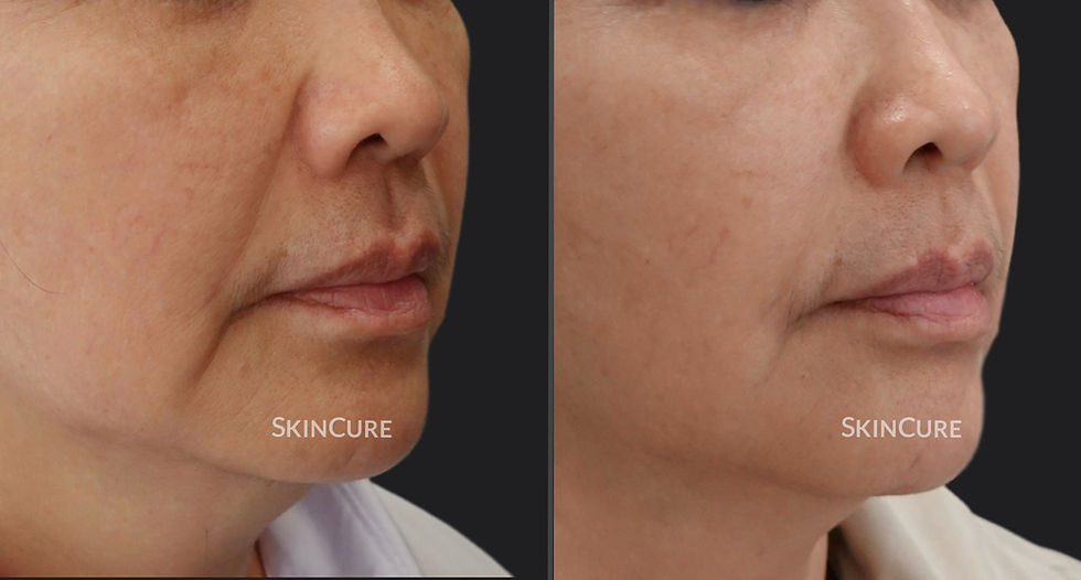Filler Smile Line