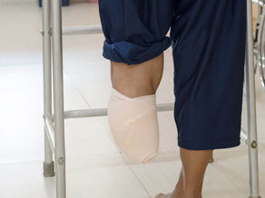 Left foot amputation