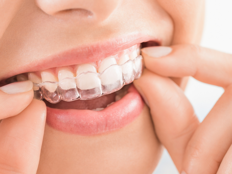 Is Invisalign or Braces Better?