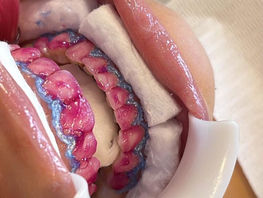 Clareamento dental realmente funciona?