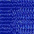 EEG_Absence_seizure_edited_edited_edited