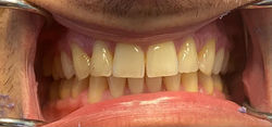 BEFORE: Bio Clear Veneers for Teeth #8,9