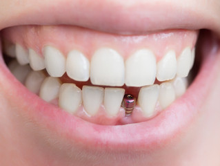 Truth About Dental Implants