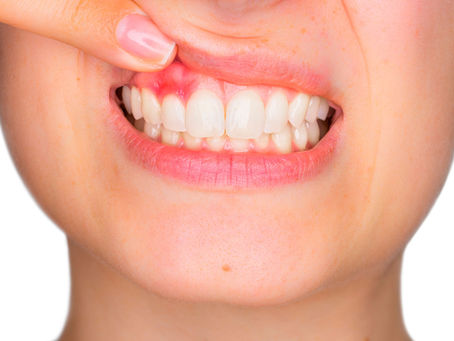 Gum Disease: Causes, Risk Factors, and Symptoms