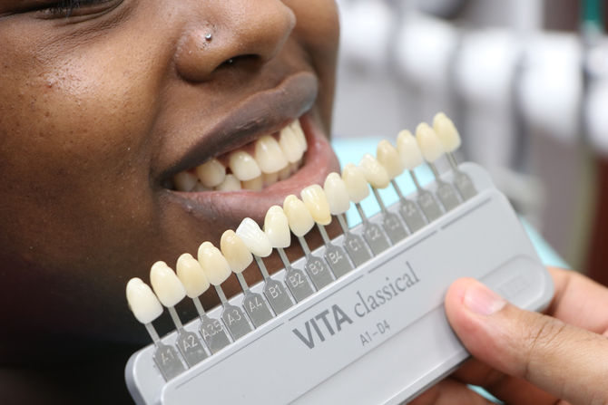 FAQs About Veneers Answered