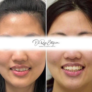 Before and After Invisalign