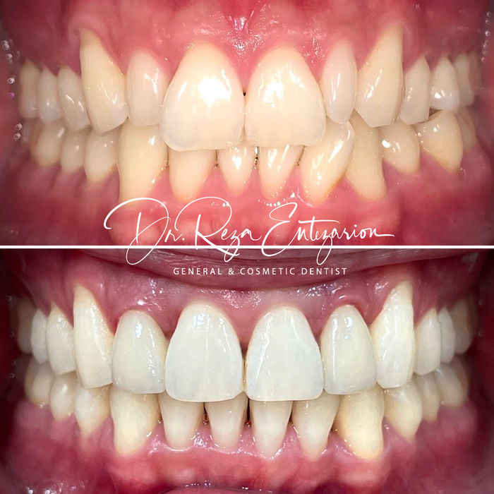 Invisalign before and after