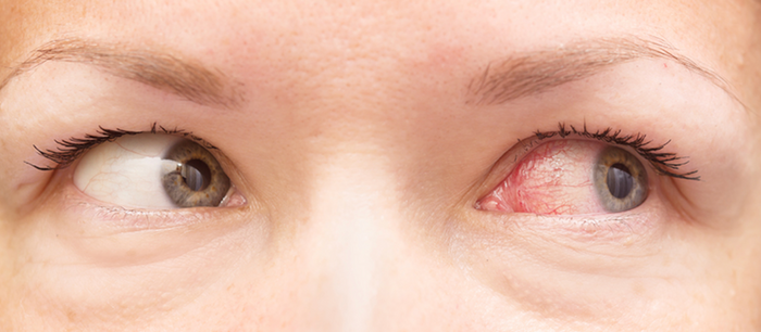 👀のどが痛い＋目が赤い？それ、アデノウイルスかもしれません〜咽頭結膜熱（プール熱）と流行性角結膜炎（はやり目）について〜