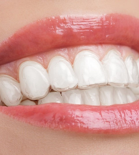 Giải pháp máng tẩy trắng răng an toàn 