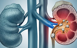 Services_kidney stones