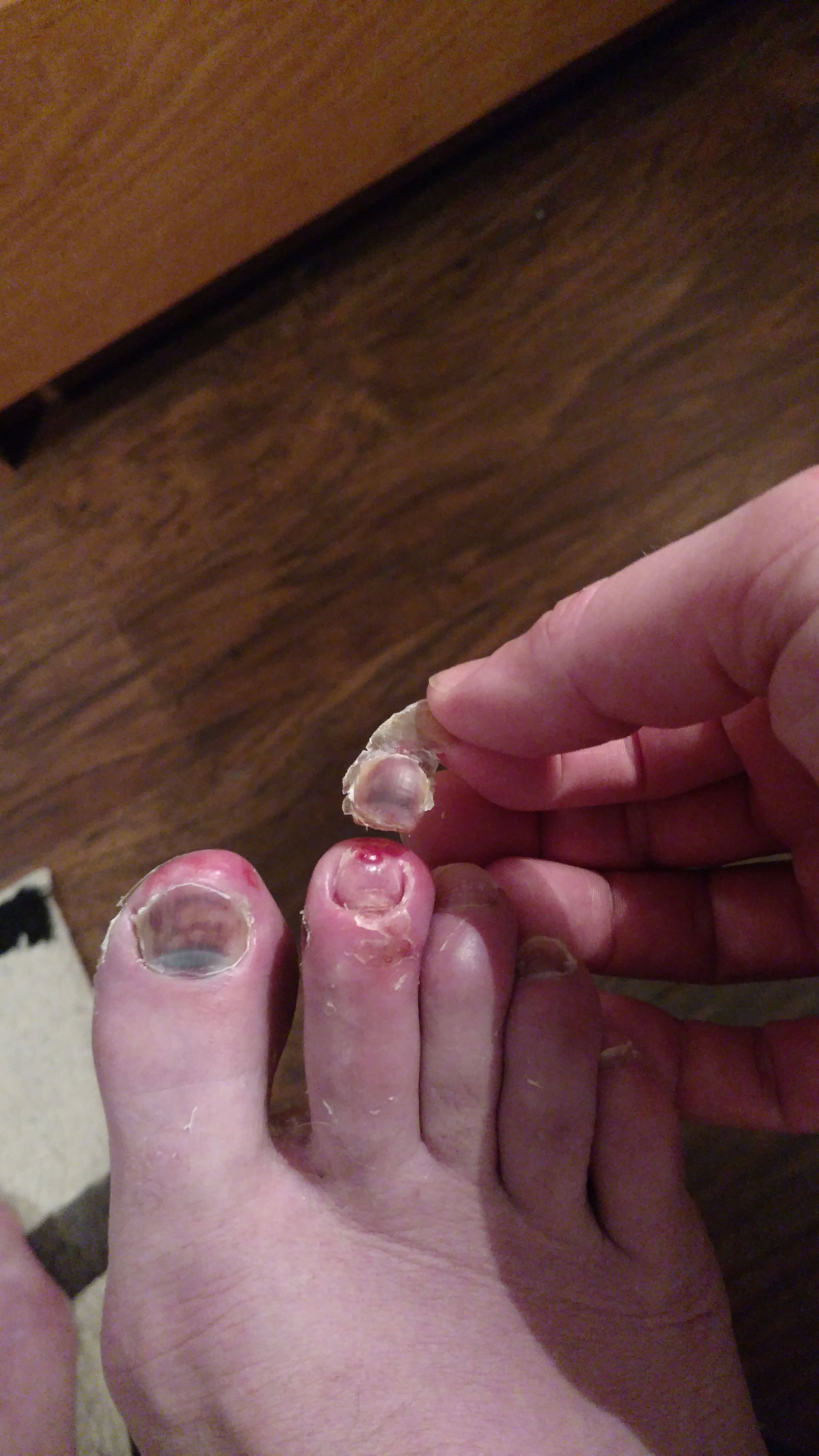 Right toenail off
