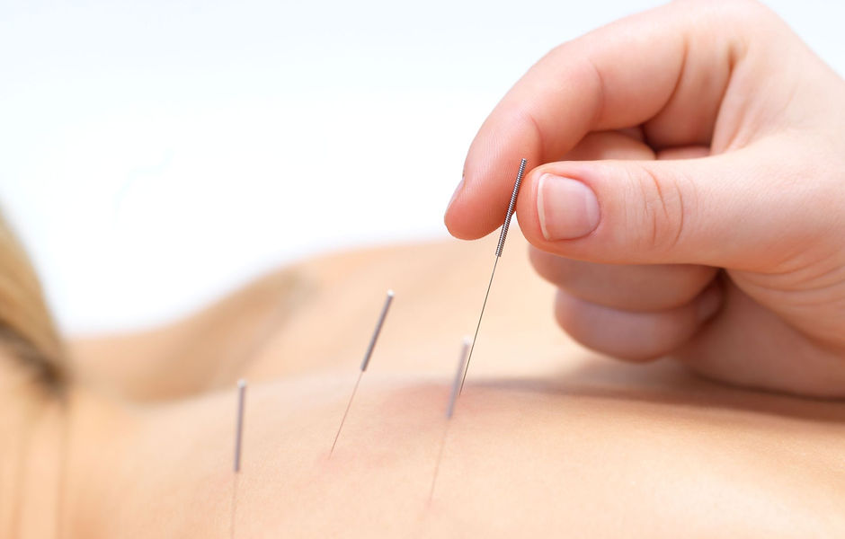 acu needles 1.jpg