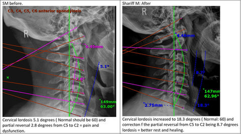 Before and after results of neck pain therapy