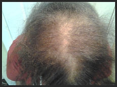 Hair Extensions, Hair weaving for Hair Loss