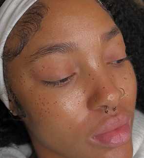 freckle enhancement