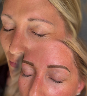 brow correction