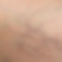 spider-veins-01.jpg