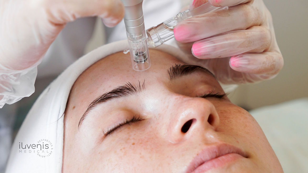 microneedling iuvenis medical.jpg
