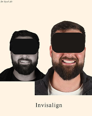 Invisalign Before and After