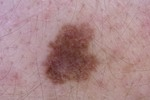 Melanoma Skin Cancer
