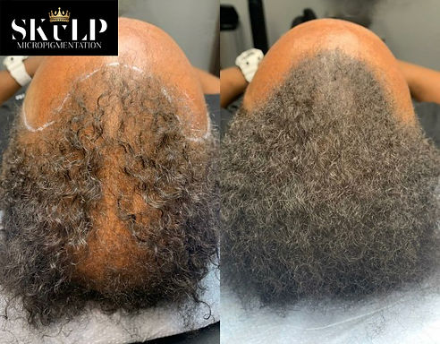 Services_Alopecia_Treatment